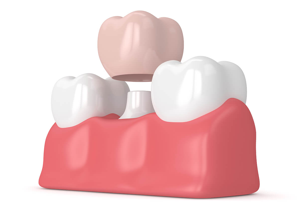How Long Do Dental Crowns in Last Irvine CA Area