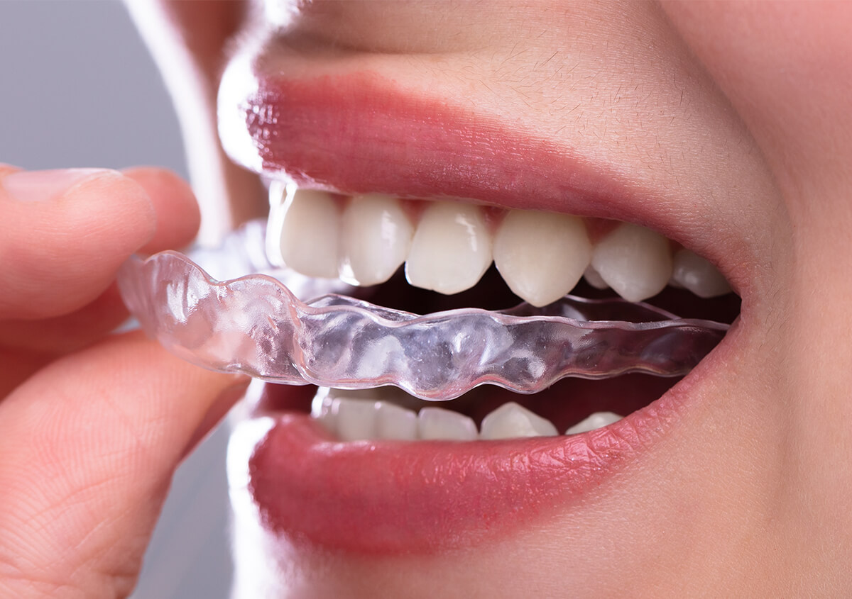 Bring Out Your Best Smile with Invisalign/Clear Aligners