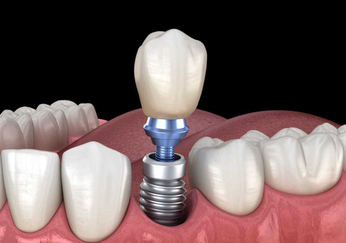 What You Should Know about Full Mouth Dental Implants