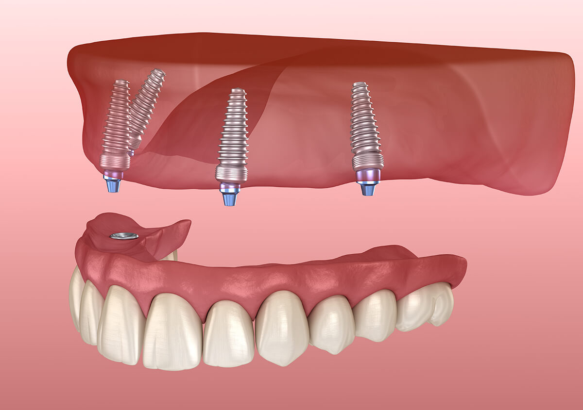 Implant Supported Dentures in Irvine CA Area