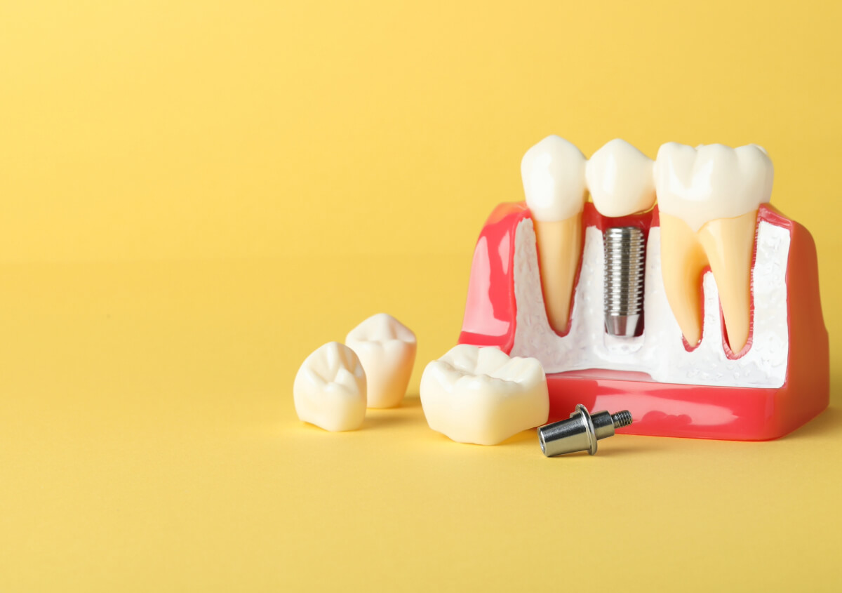Are You a Good Candidate for Dental Implant Surgery?
